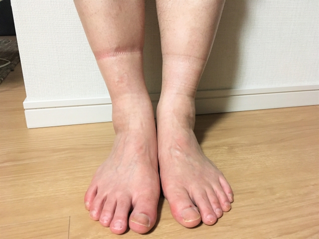 足が冷える人ほどむくみに気づいていない